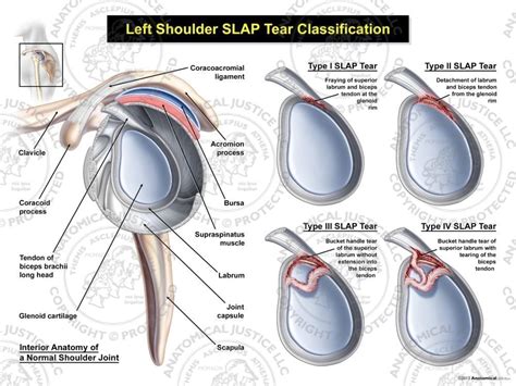 test for slap tear|grades of slap tear.